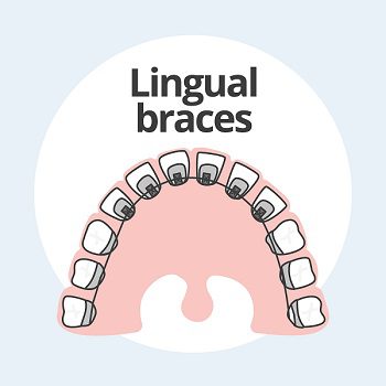 Adult Orthodontics: Pros and Cons of Lingual Braces