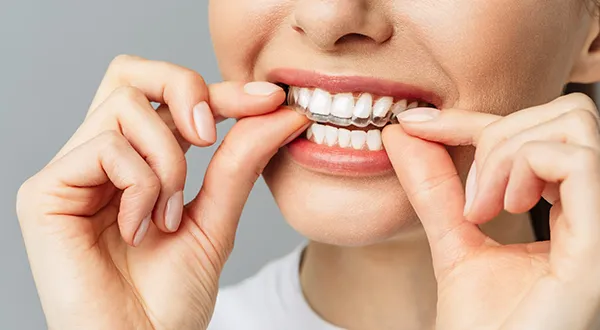 Introduction to Clear Aligners