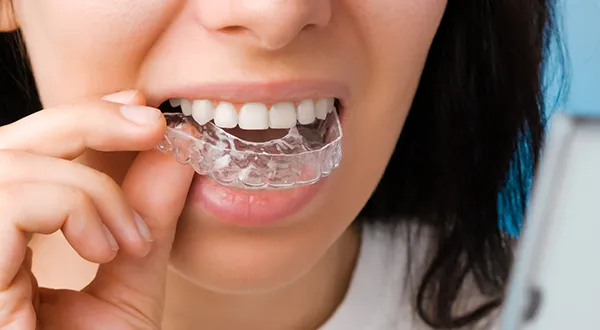 Invisalign Treatment: Who Is a Good Candidate? 
