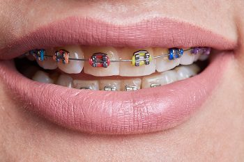 Metal braces