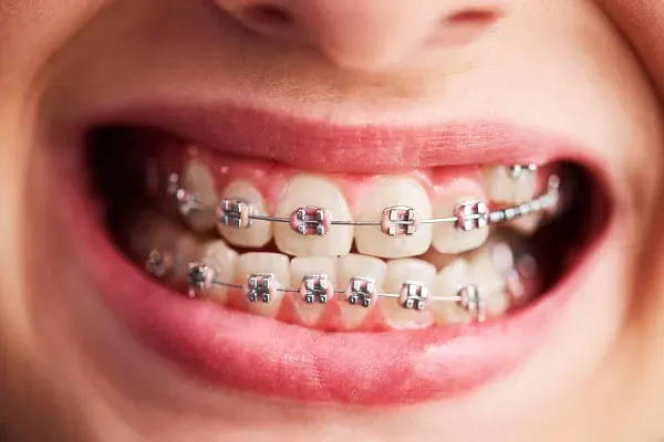 Poking wire braces