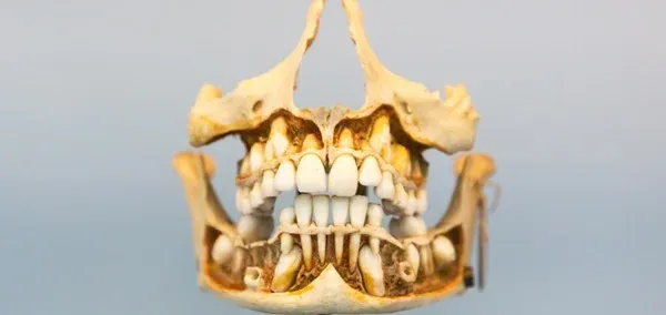 Facial Asymmetry