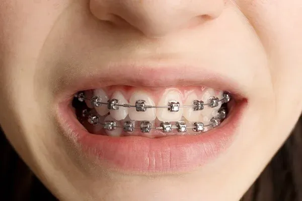 Braces